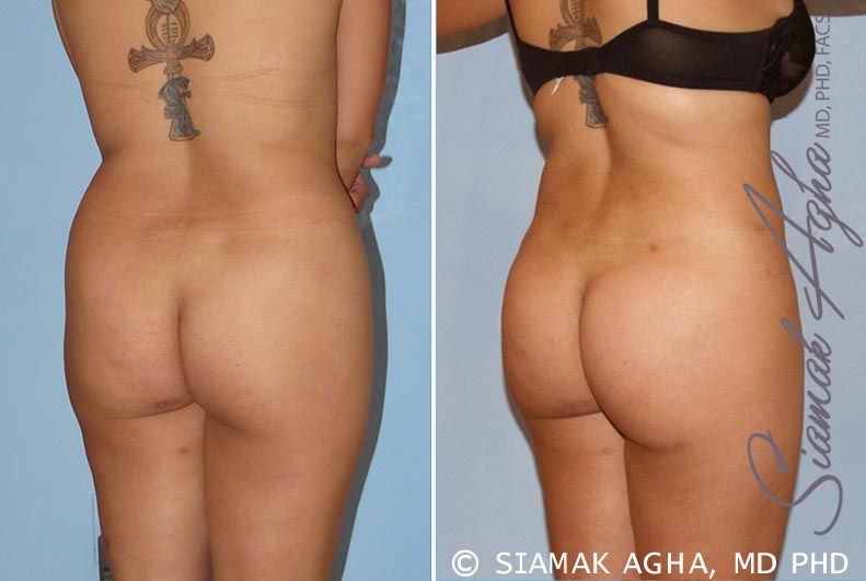Brazilian Butt Lift Before & After