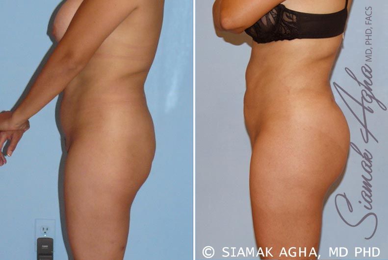 Brazilian Butt Lift Before & After