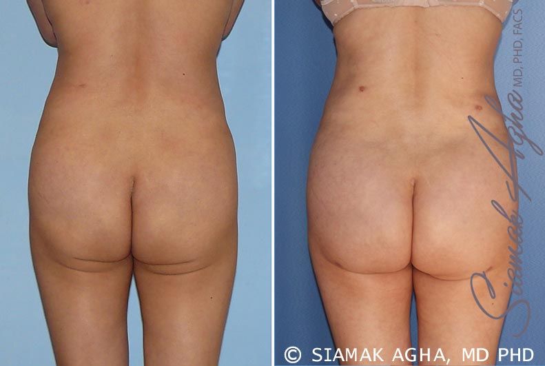 Brazilian Butt Lift Before & After