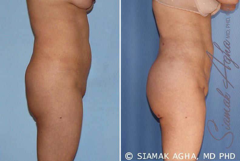 Brazilian Butt Lift Before & After