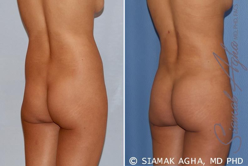 Brazilian Butt Lift Before & After