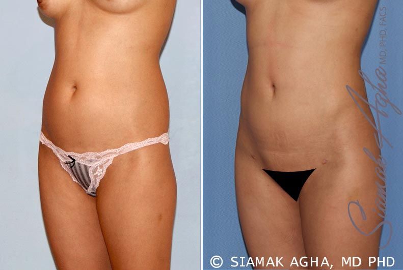 Brazilian Butt Lift Before & After