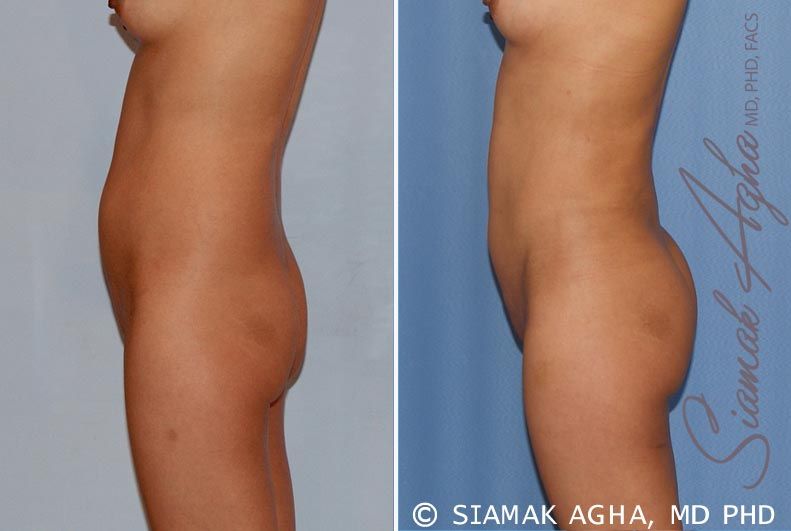 Brazilian Butt Lift Before & After