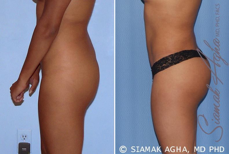 Brazilian Butt Lift Before & After