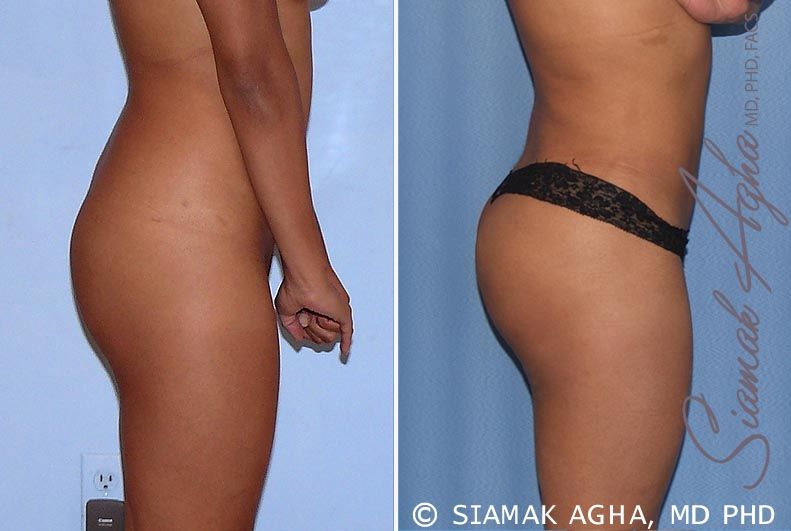 Brazilian Butt Lift Before & After