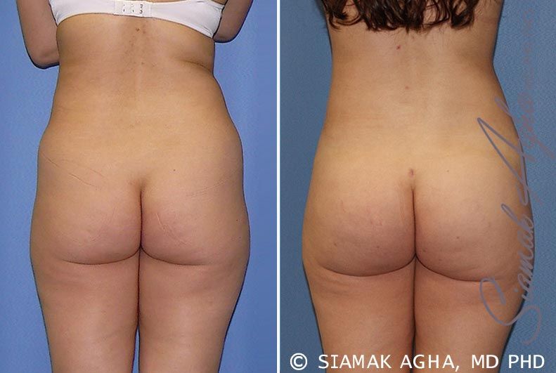 Brazilian Butt Lift Before & After