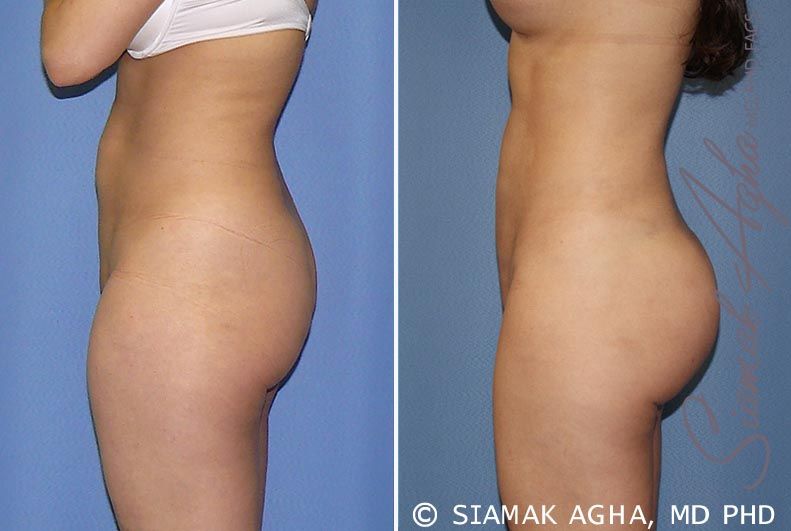 Brazilian Butt Lift Before & After