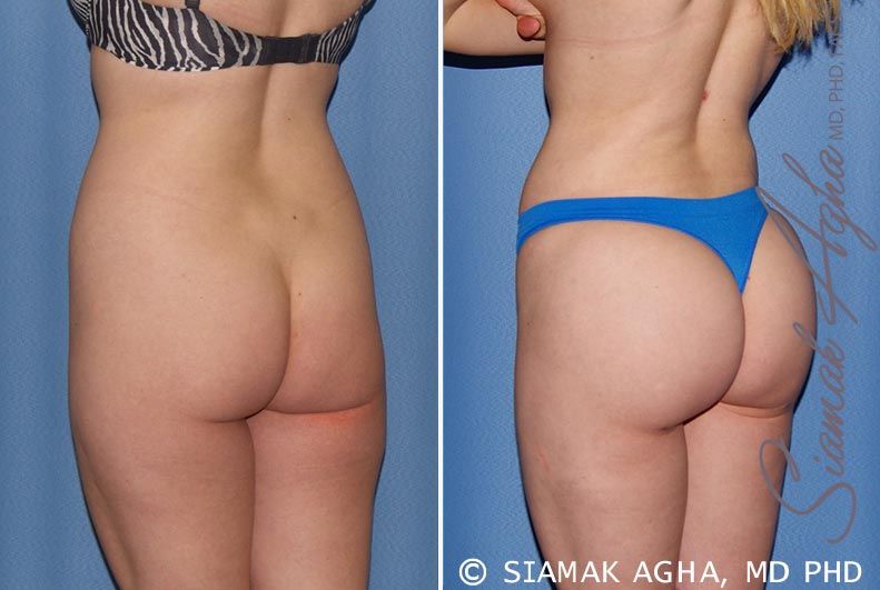 Brazilian Butt Lift Before & After