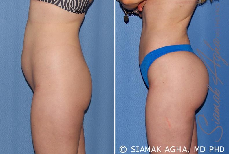 Brazilian Butt Lift Before & After