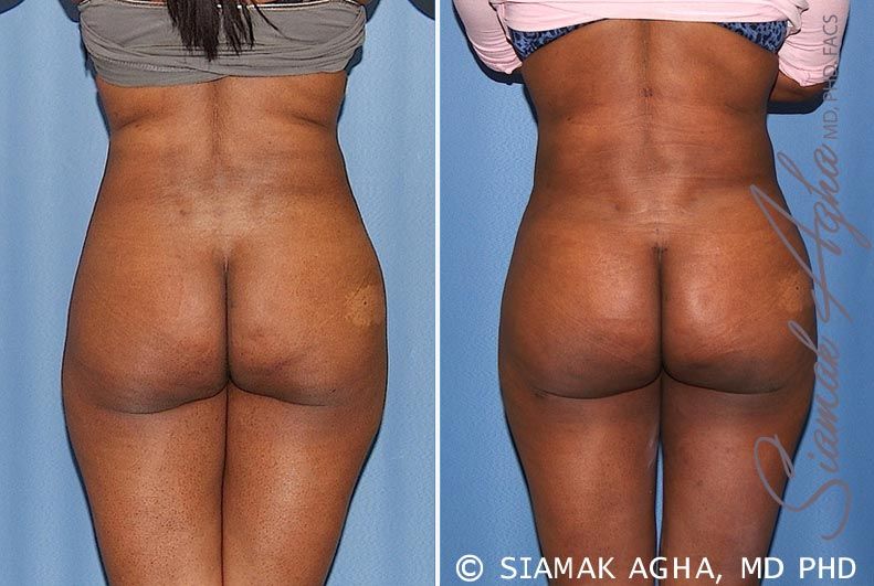 Brazilian Butt Lift Before & After