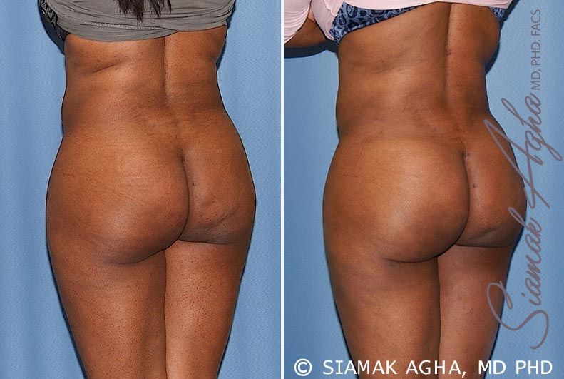 Brazilian Butt Lift Before & After