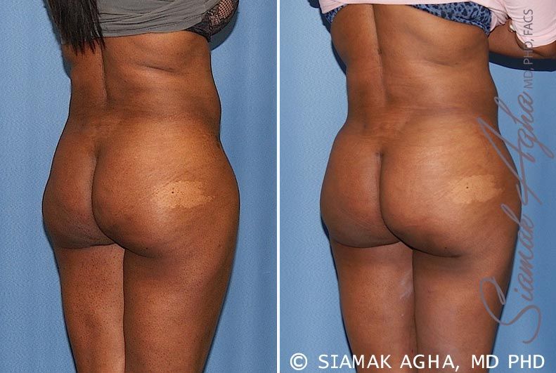 Brazilian Butt Lift Before & After