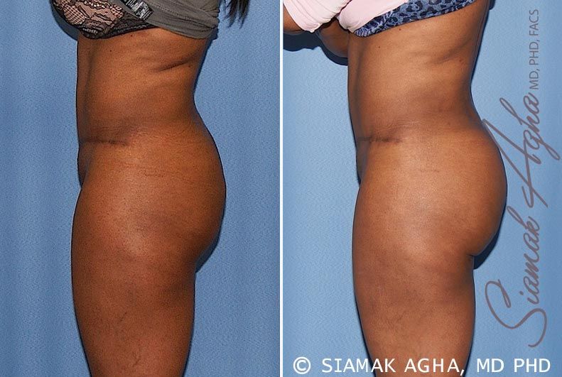 Brazilian Butt Lift Before & After