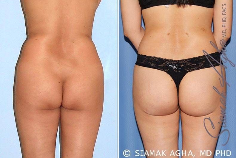 Brazilian Butt Lift Before & After
