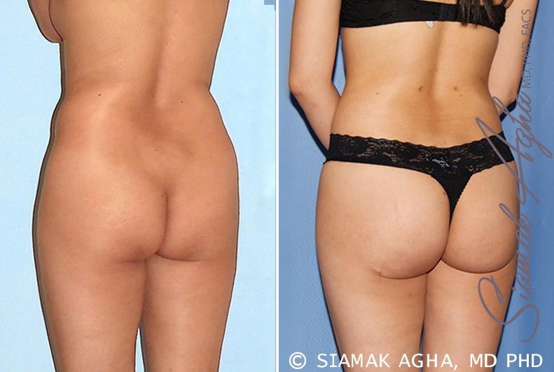Brazilian Butt Lift Before & After