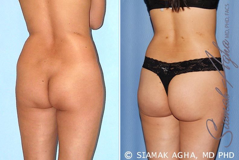 Brazilian Butt Lift Before & After