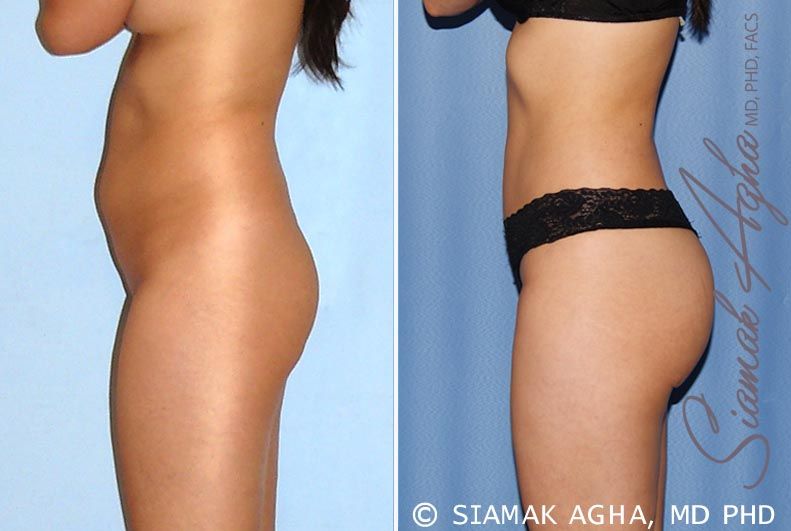 Brazilian Butt Lift Before & After