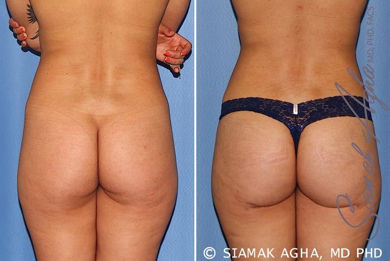 Brazilian Butt Lift Before & After
