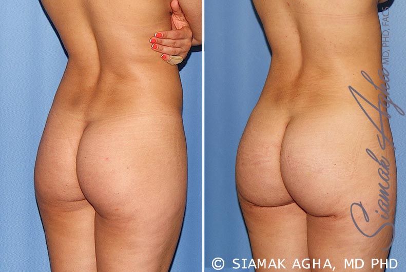 Brazilian Butt Lift Before & After