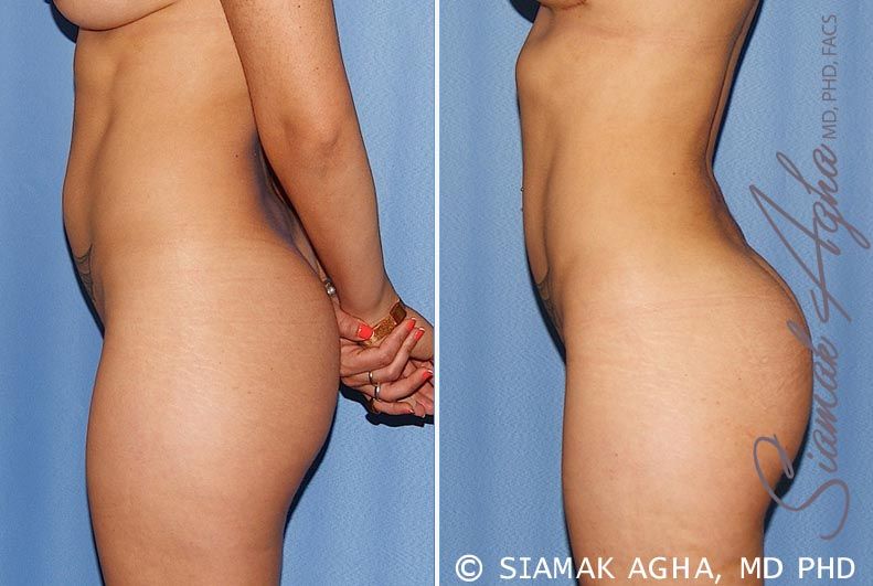 Brazilian Butt Lift Before & After
