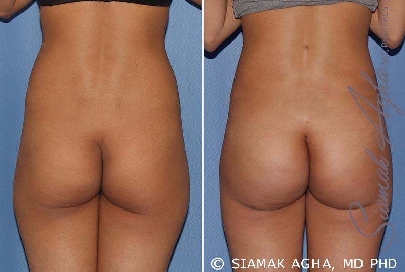 Brazilian Butt Lift Before & After