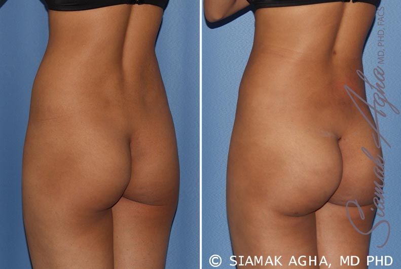 Brazilian Butt Lift Before & After