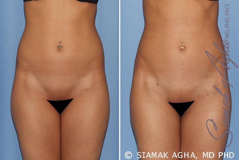 Brazilian Butt Lift Before & After