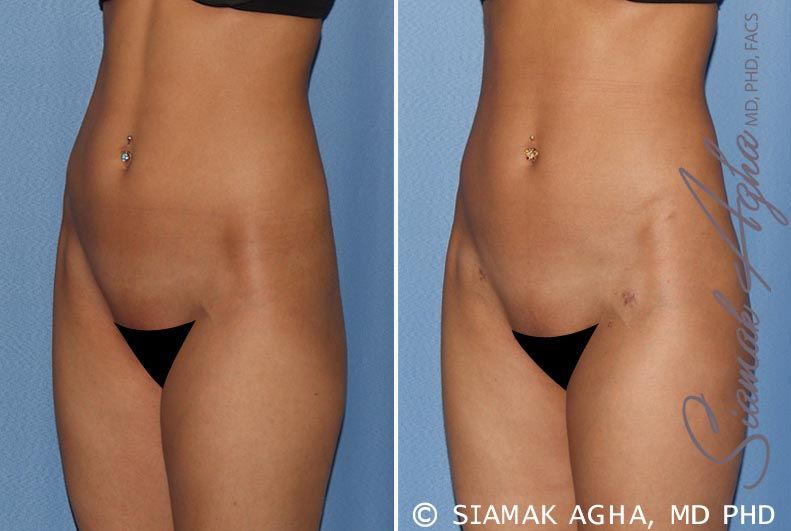 Brazilian Butt Lift Before & After