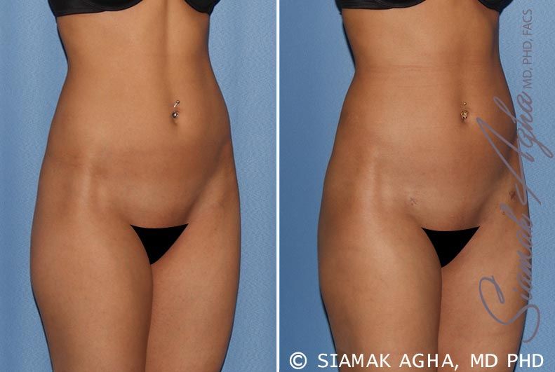 Brazilian Butt Lift Before & After