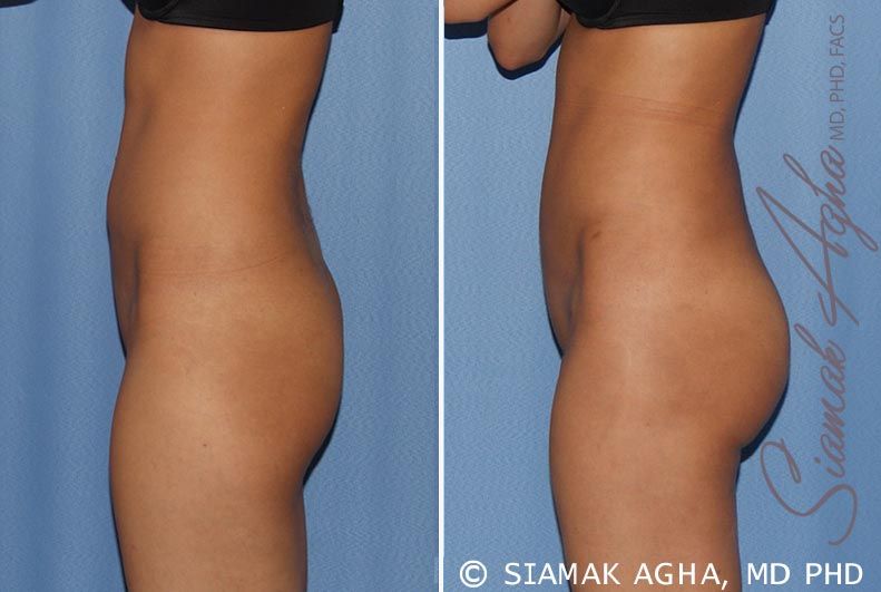 Brazilian Butt Lift Before & After