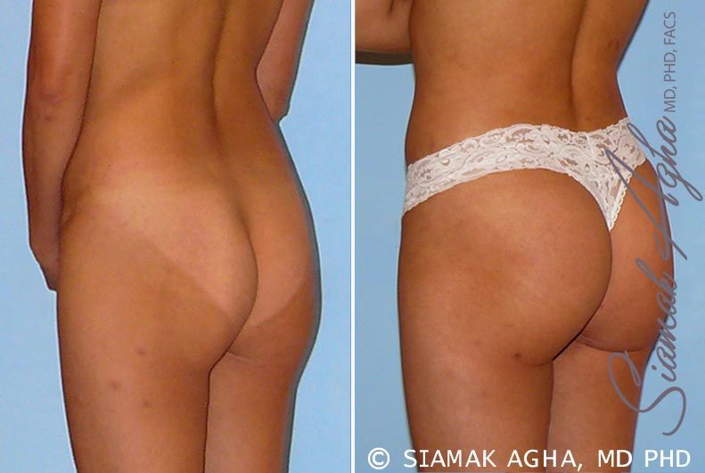 Brazilian Butt Lift Before & After