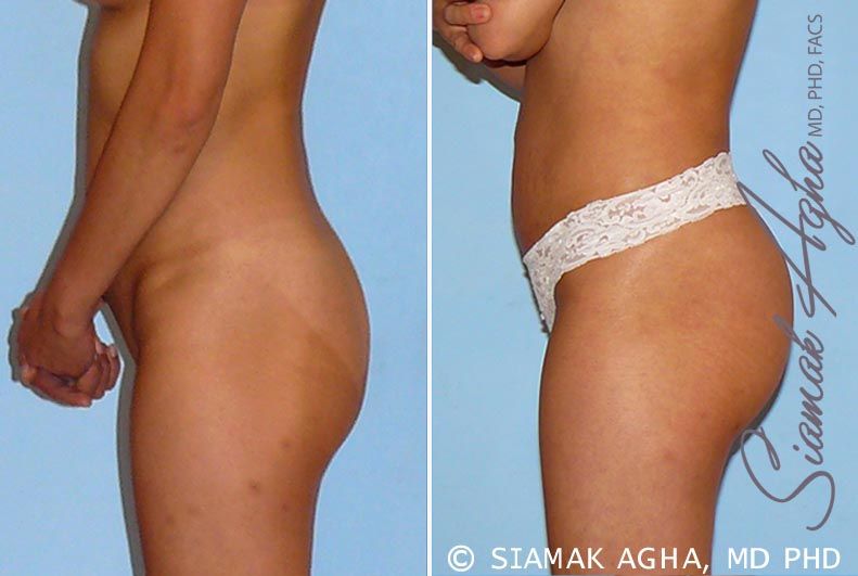 Brazilian Butt Lift Before & After