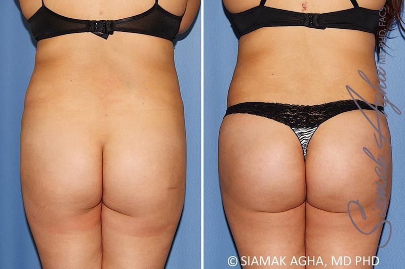 Brazilian Butt Lift Before & After