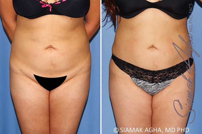 Brazilian Butt Lift Before & After