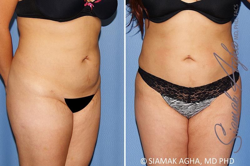 Brazilian Butt Lift Before & After