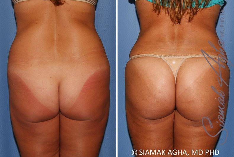 Brazilian Butt Lift Before & After