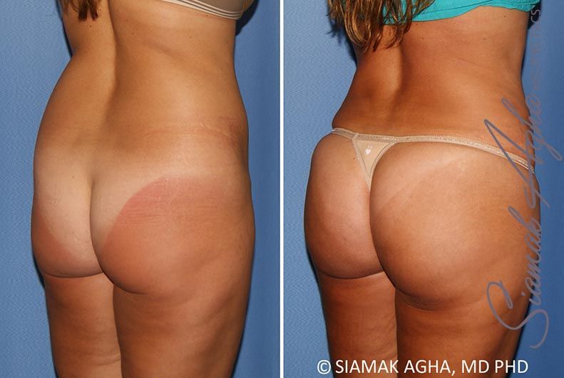 Brazilian Butt Lift Before & After