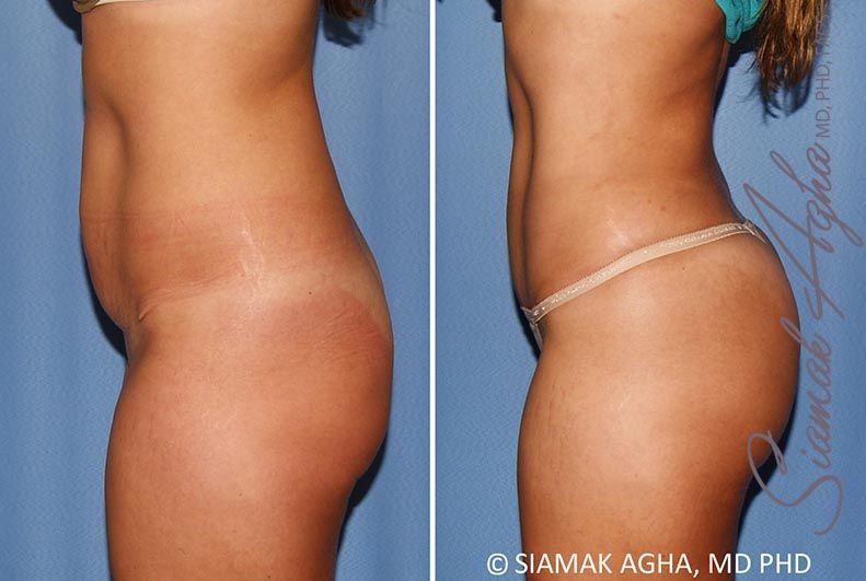 Brazilian Butt Lift Before & After