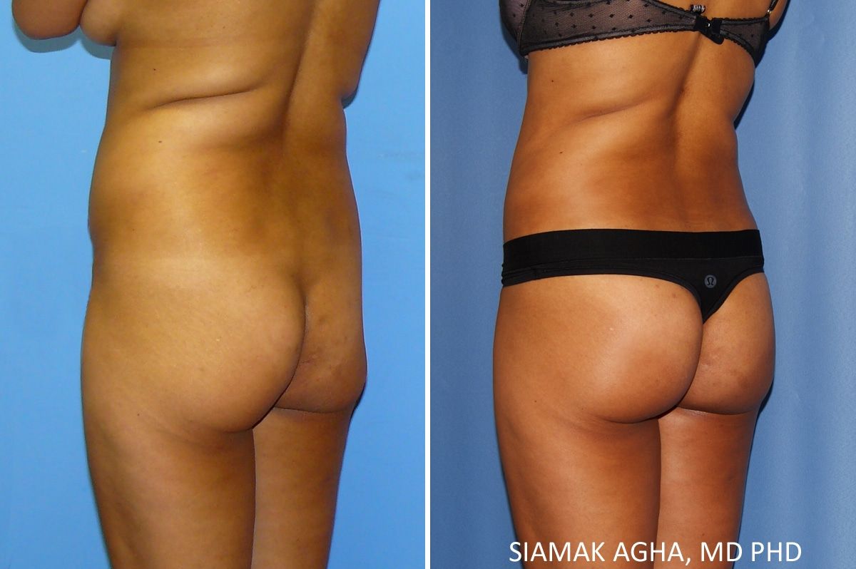 Brazilian Butt Lift Before & After