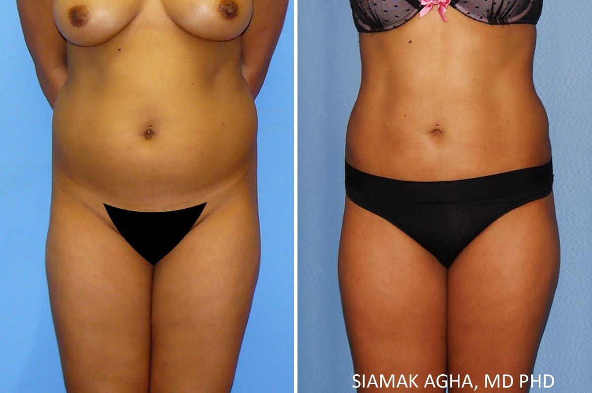 Brazilian Butt Lift Before & After