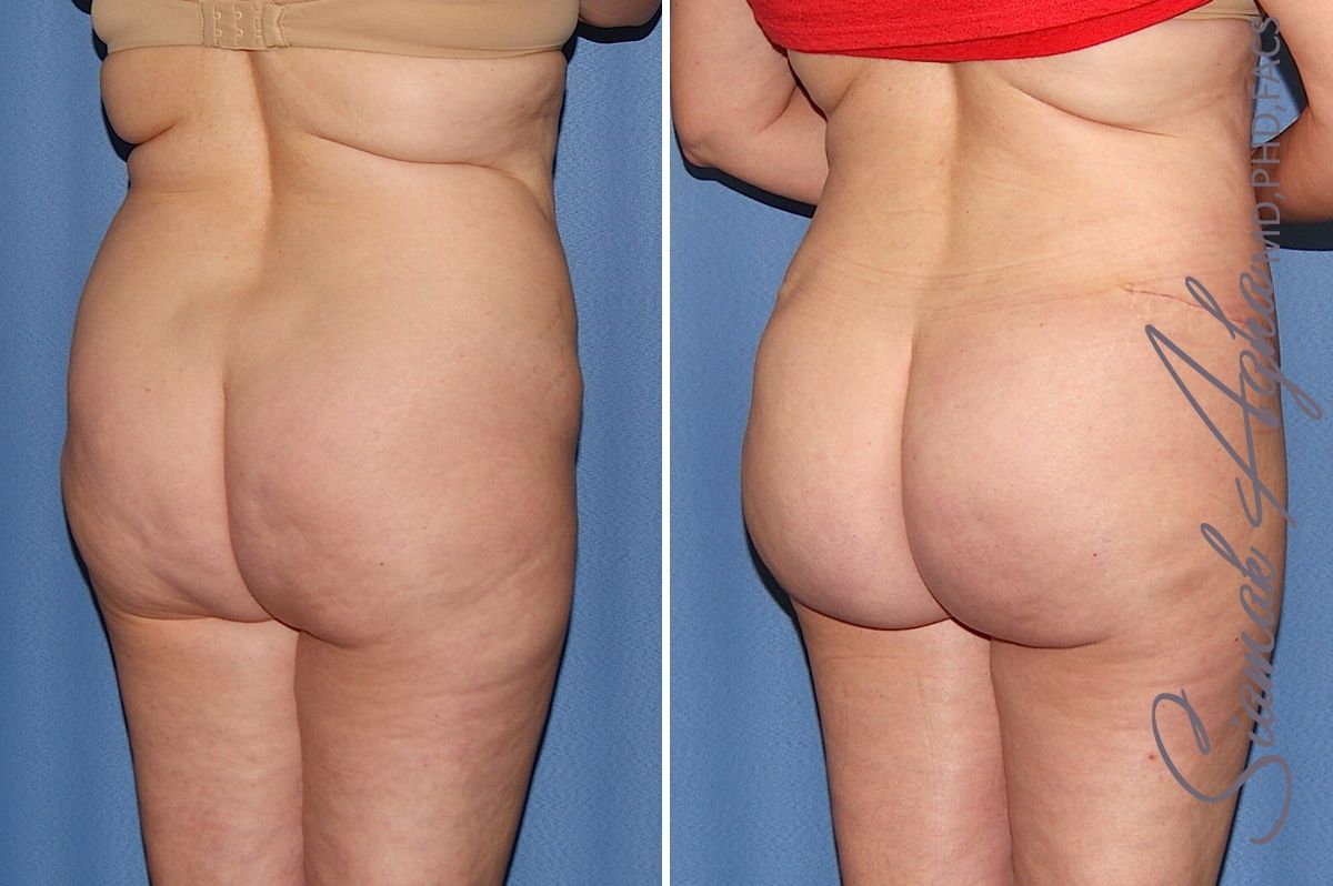Brazilian Butt Lift Before & After