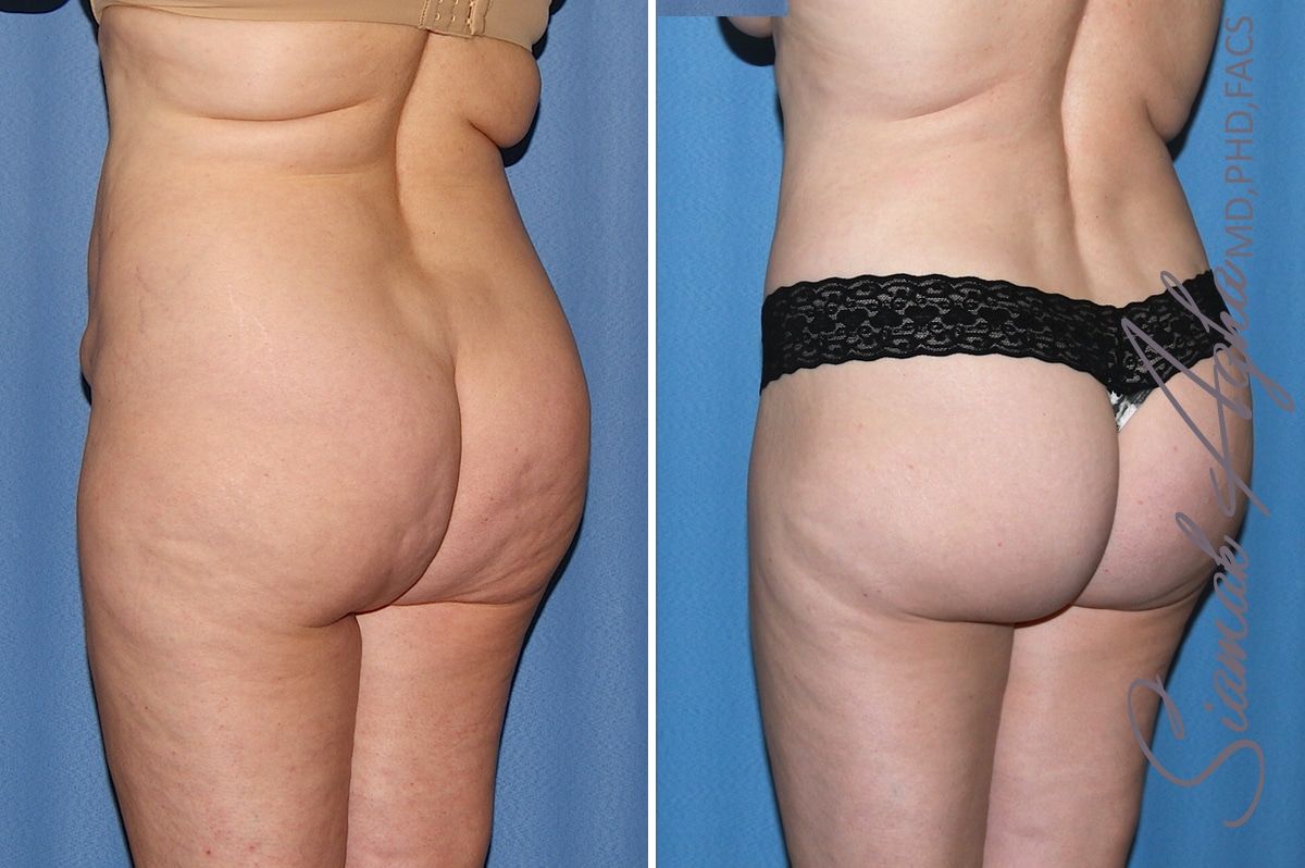 Brazilian Butt Lift Before & After
