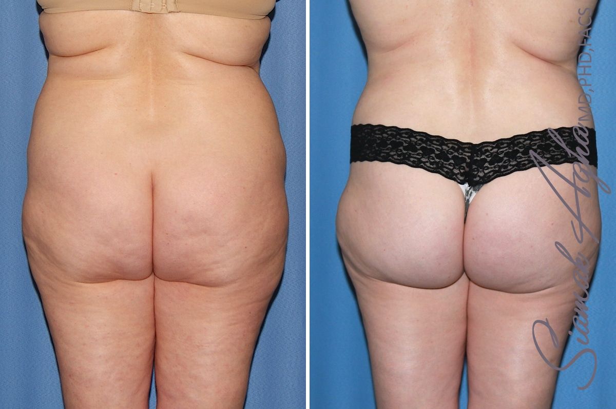 Brazilian Butt Lift Before & After