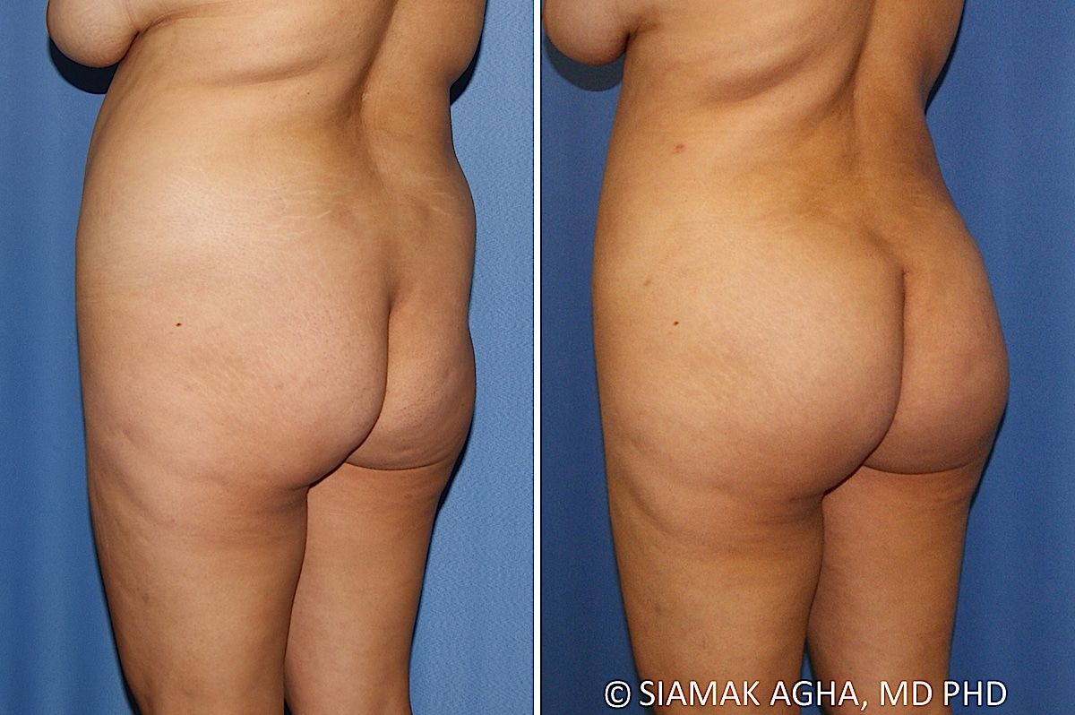 Brazilian Butt Lift Before & After