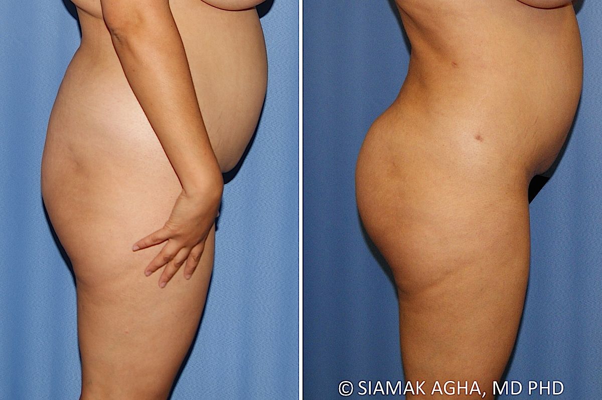 Brazilian Butt Lift Before & After