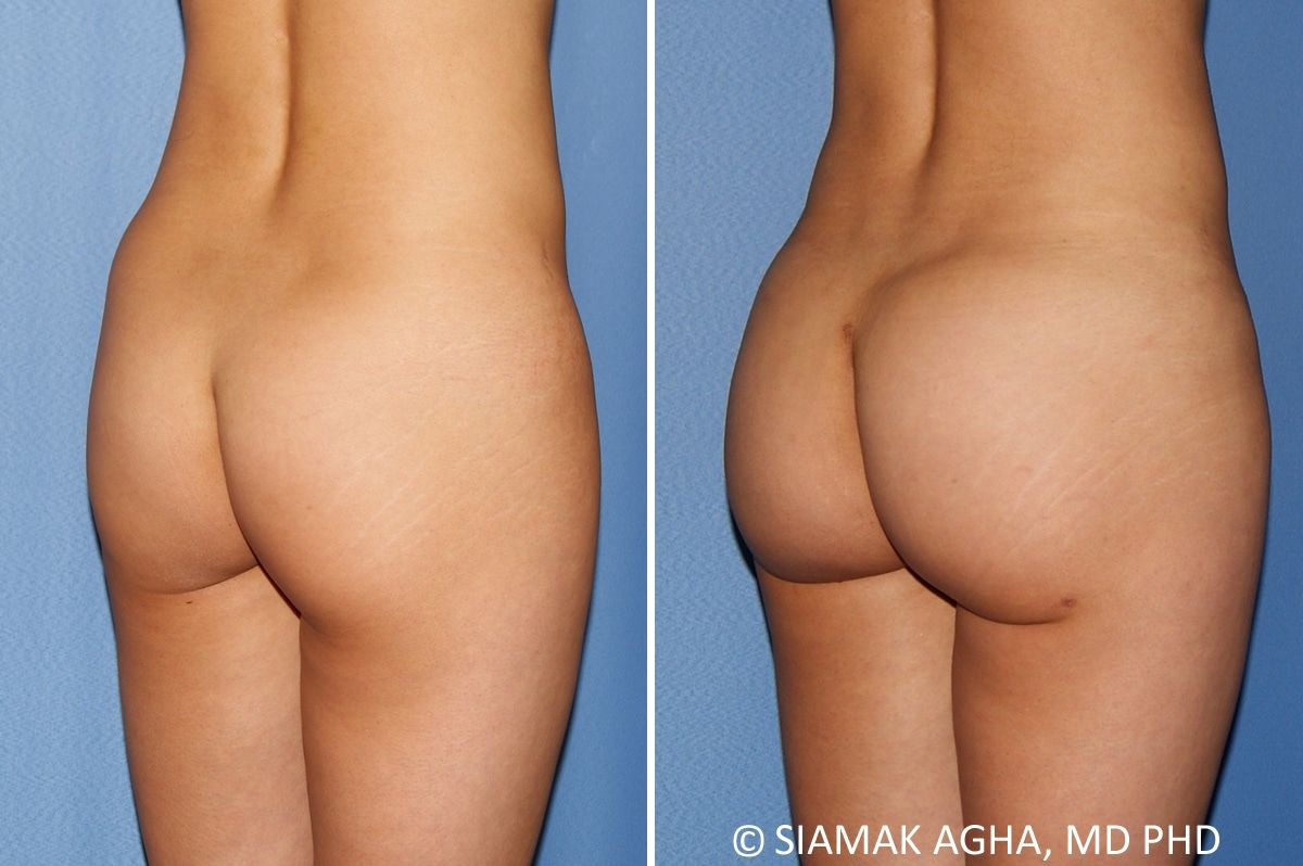 Brazilian Butt Lift Before & After