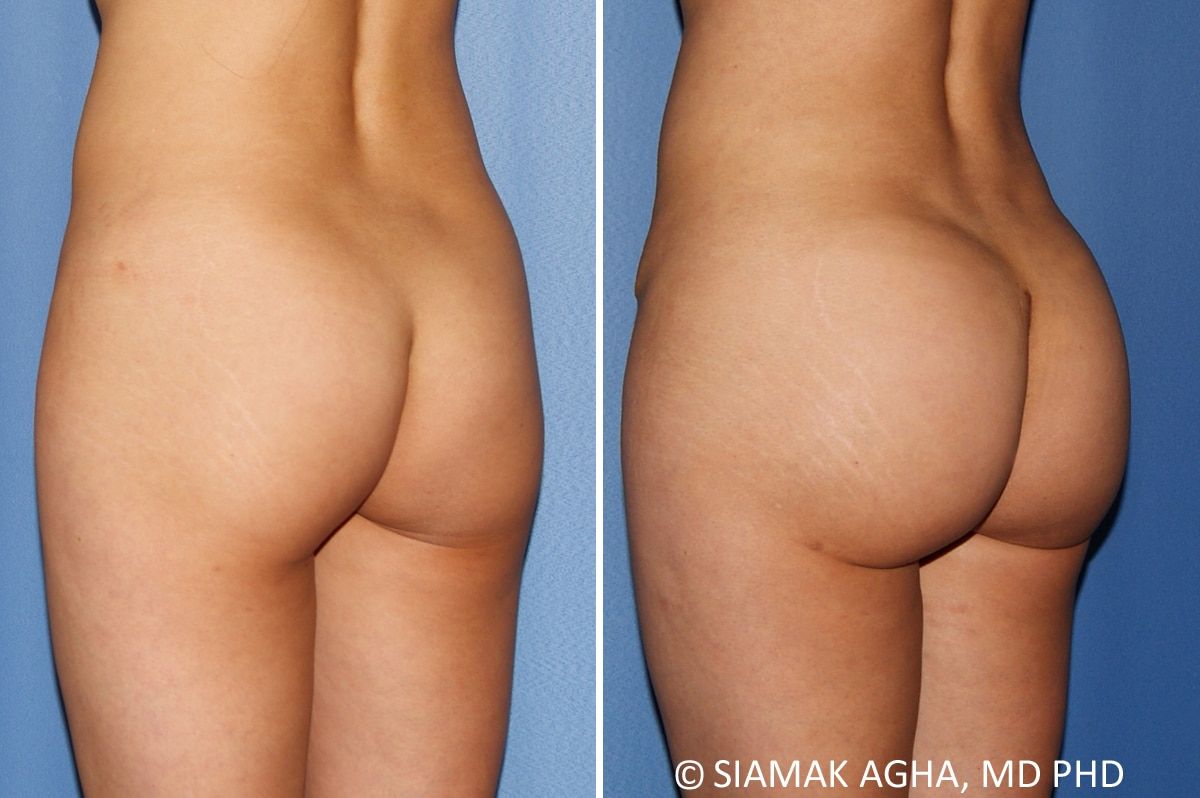 Brazilian Butt Lift Before & After