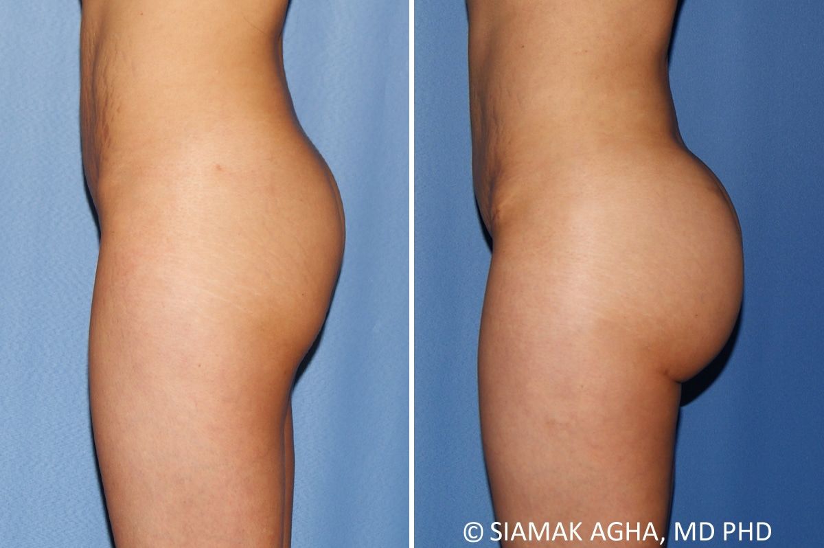 Brazilian Butt Lift Before & After