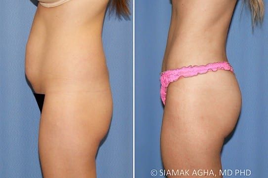 Brazilian Butt Lift Before & After