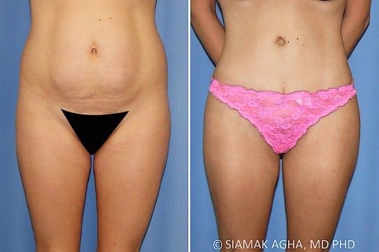 Brazilian Butt Lift Before & After